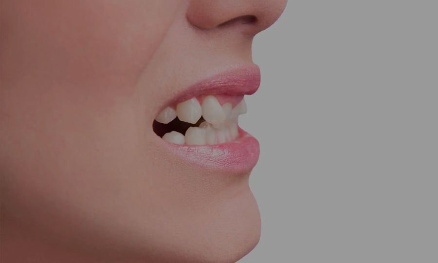 cricket teeth