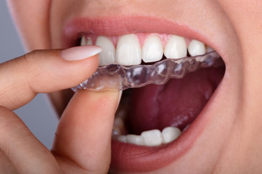 4 Home Emergency Care Tips For Invisalign Aligners 