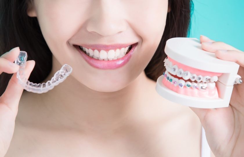 Clear Braces: Aligners & Teeth Straightening